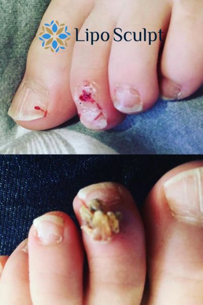 Wart removal customer results from Lipo Sculpt Sandy